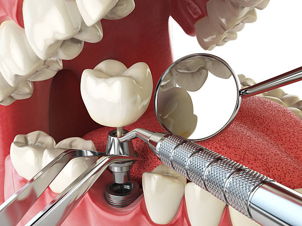 Best Emergency Dental Extractions in Piru, CA